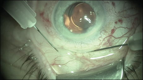 Pars plana approach can be used for surgical injection ...