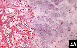 Figure 4A: A peripheral rim of cartilage