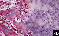Figure 4B: The stroma between the bony trabeculae is comprised of loosely arranged fibrovascular tissue